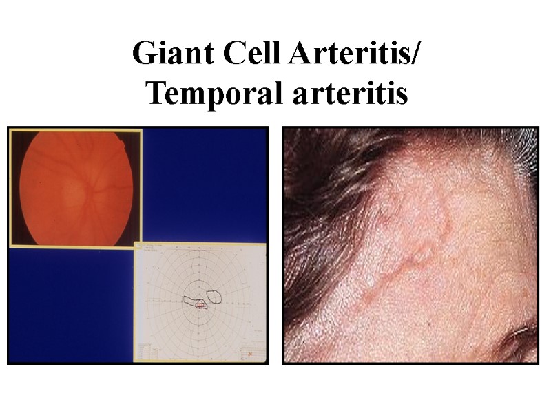 Giant Cell Arteritis/ Temporal arteritis